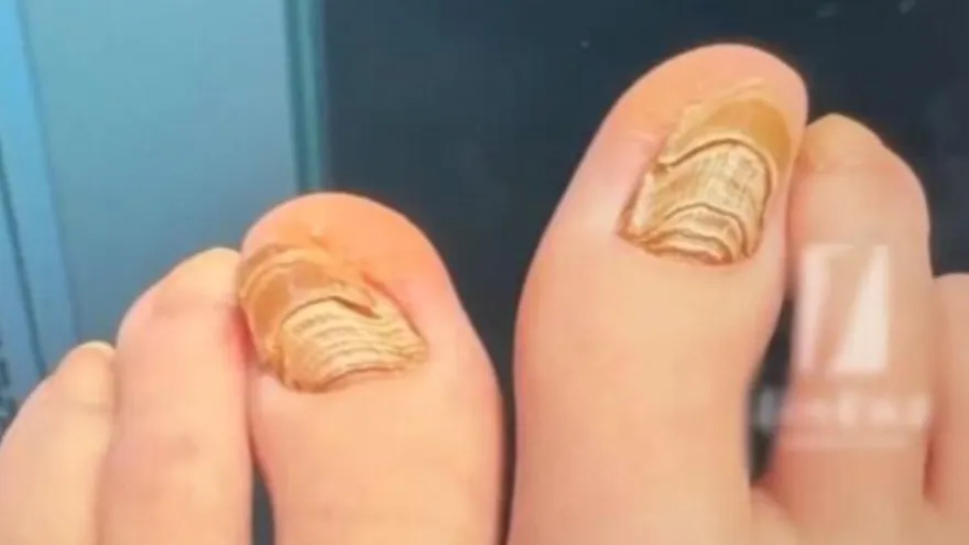 襪子沒脫就睡覺！杭州女腳甲如千層蛋糕　醫：整片得拔掉