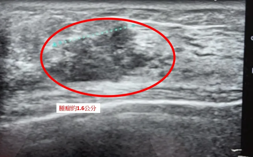 一側乳房三顆腫瘤！「全切除併雙側重建」術後5天上工