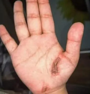 陸女邊充電邊玩手機！遭電流「竄全身」口舌流血燒傷命危