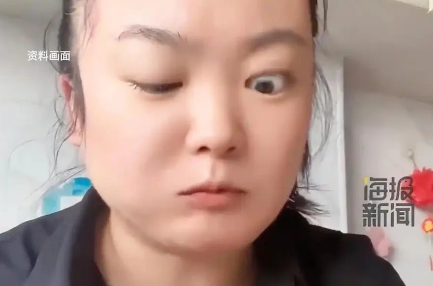 影/咀嚼時眼睛會動？陸女一吃東西變「大小眼」　醫揭罕見真相