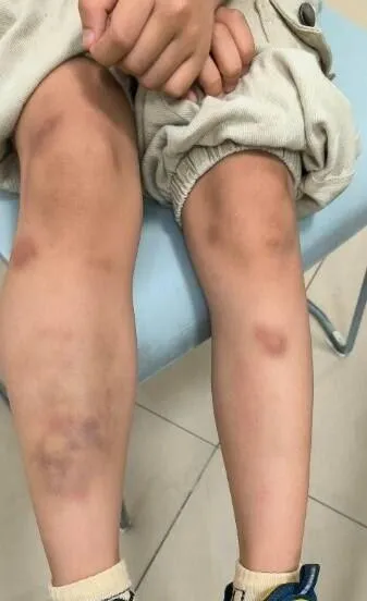 不是血癌！6歲童全身瘀青　醫：體內這種蟲卵爆滿...