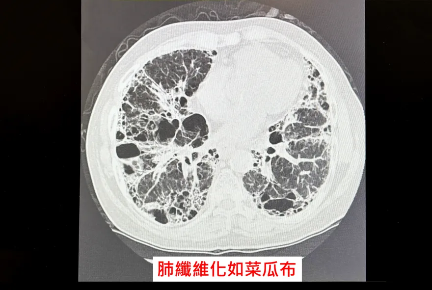 8旬翁菸齡50年…喘吁吁一年！就醫才知肺變「菜瓜布」