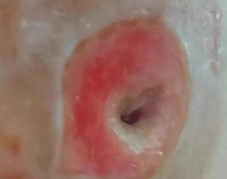 嚇！陸女誤把「皮脂腺囊腫」當痘痘擠　臉部驚現「恐怖黑洞」