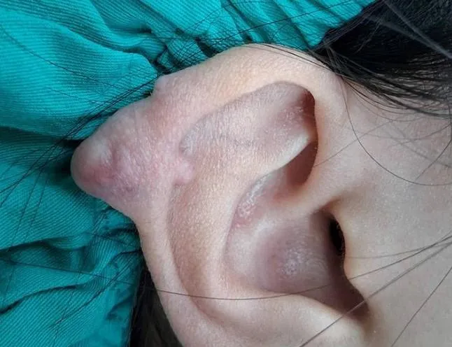穿耳洞竟變「精靈耳」！19歲女耳廓蟹足腫外凸變形