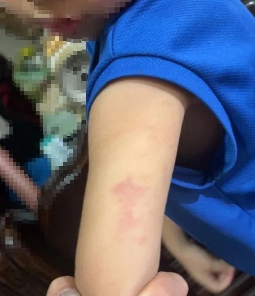 幼兒園涉虐童！家長心疼兒手臂大片瘀青　基隆市府要嚴查了