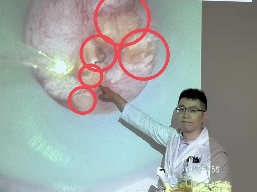 追劇忘喝水！婦半年三度腎結石　雙腎佈滿結石如雜糧麵包