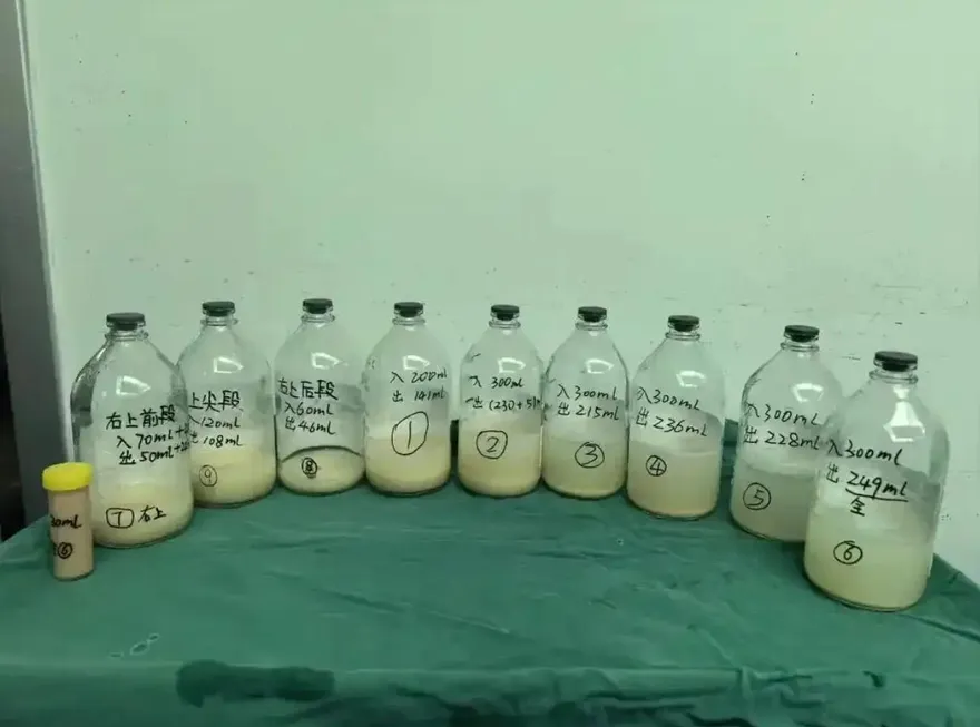 肺洗出3L「牛奶」！陸女童久咳2個月　醫揭患「肺泡蛋白沉積症」