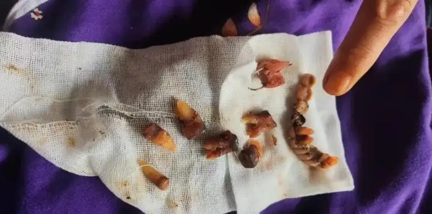 看一顆牙竟拔光12顆！陸翁遭過度植牙「滿嘴血」存款全被刷光
