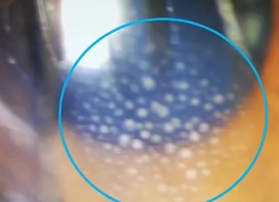 24歲女眼角膜長出「青春痘」 醫揭原因：太熱啦！