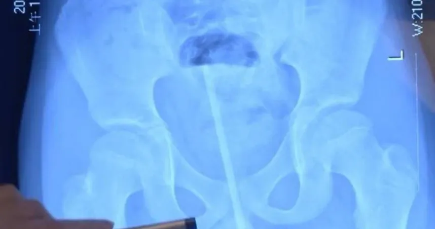 10歲童「體溫計誤插尿道」斷兩截　6.5公分殘端滑進膀胱出血急送醫