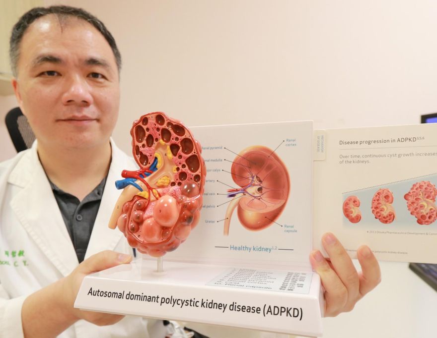 男腰痛、血尿導致腎臟腫3倍大「如一串葡萄」！醫籲及早篩檢以防洗腎