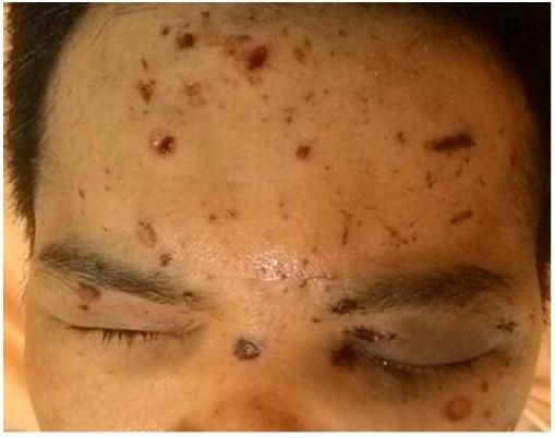 卡式爐「氣爆」意外40歲男視力僅剩0.2！台中榮總挽救珍貴視力