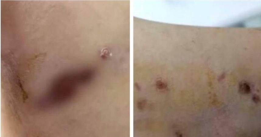 花錢受罪！愛美打抽脂針反「皮膚潰爛」　醫揭：清創後恐留疤