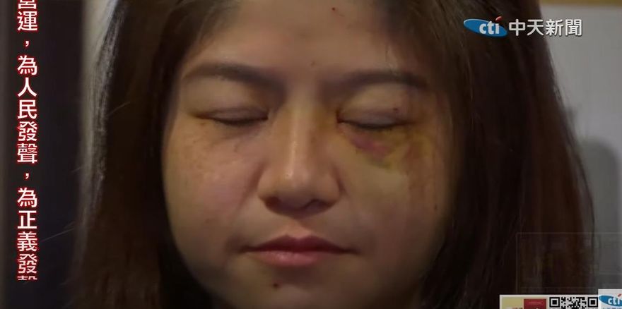 太玄宮女執事稱臉是被眼鏡刮傷　網友：怎麼看都是瘀青