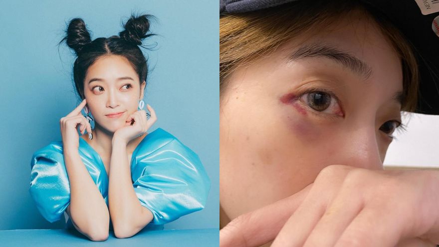 明星羽球隊賽遭K！貝童彤「眼周紅腫、瘀青」曝傷勢：水逆是不是…
