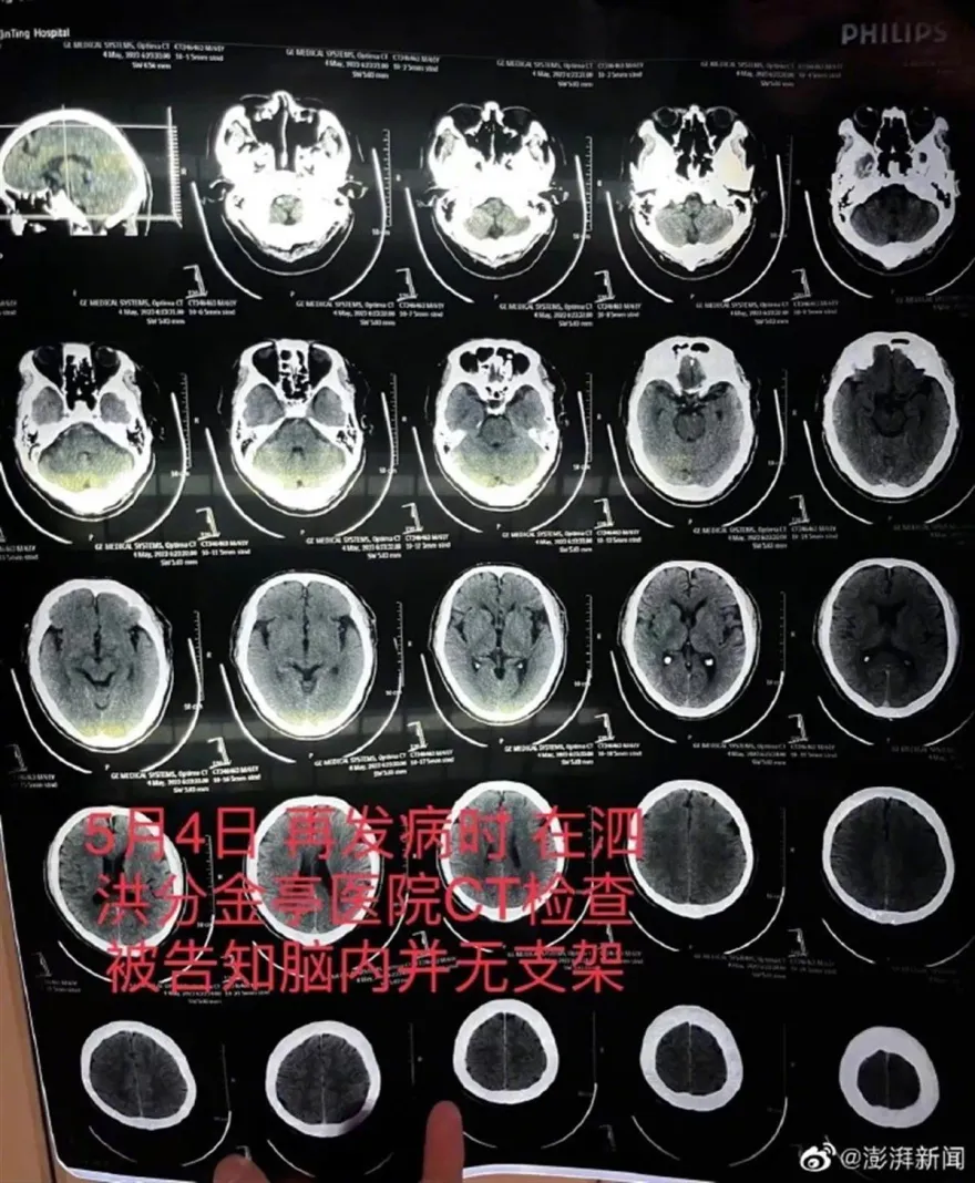 腦中風送醫才知「20萬支架不見了」　醫師認瞞手術失敗：覺得下不了台