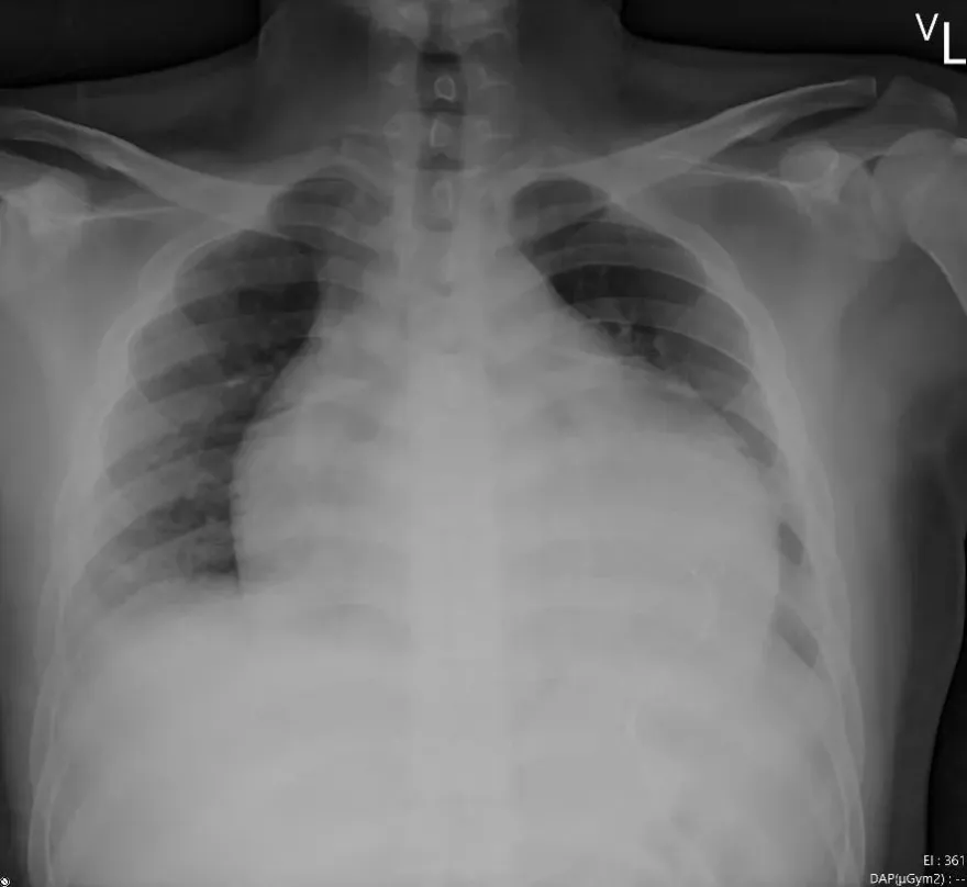 發燒、肌肉痠痛　誤認感冒險猝死！醫揭「急性心肌炎」4症狀須警覺