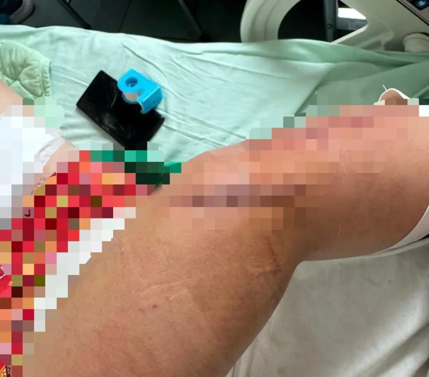 台南仁德服務區驚見隨機砍人！　肌腱斷裂全身中多刀