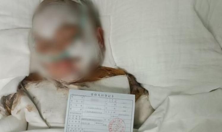 慘！陸5歲童掉進「整鍋滾燙豆漿」　全身80%燙傷命危