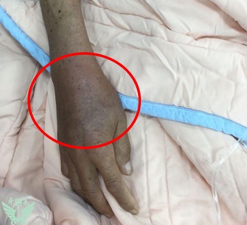 反覆發作的痛風好痛苦？醫師提醒：漠視不治療下場慘　腎臟病風險飆高