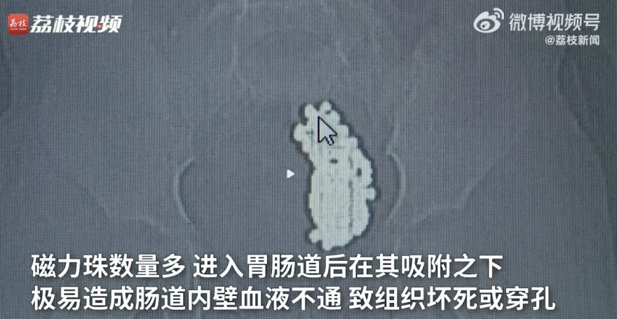 嚇壞！3歲女童連續嘔吐、腹痛不止　父送醫檢查照X光嚇壞：腸道「上百顆魚卵」結成一大球