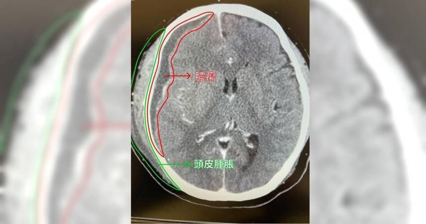 牙齦腫痛2天「呼吸困難休克」！49歲男爆深頸感染　醫警告5族群：致命風險高