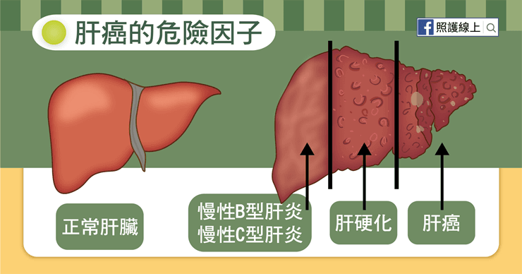 肝膽名醫罹肝癌　腫瘤破掉出血　竟是「天天愛吃這1物」！