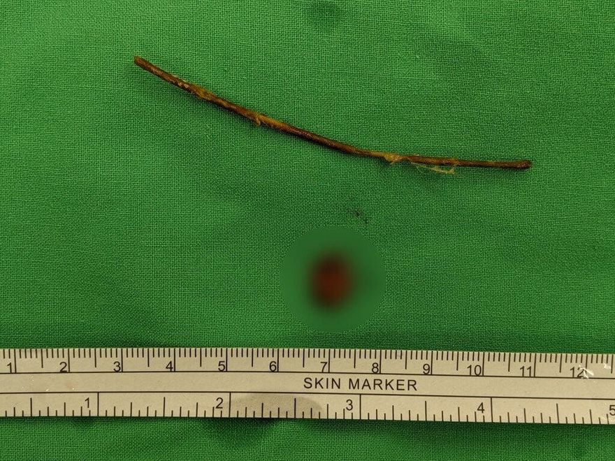 悚！1歲女童腹痛就醫　驚見「9公分樹枝」穿腸