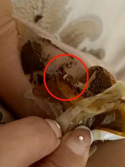 噁！女兒發燒推拿店買膏藥貼　隔天揭開驚見蠕動活蟲