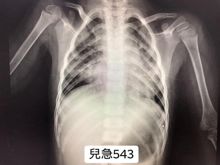 流感季節來臨　醫警告：小朋友注意！「RSV」似乎正在爆發中