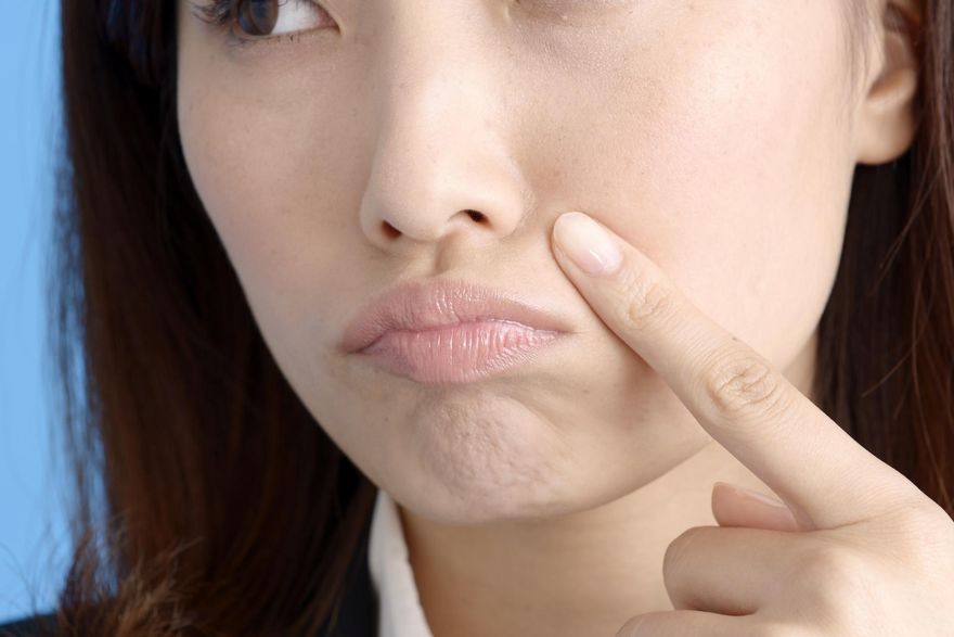 痘痘粉刺一直來！醫曝擦「1神器」有效改善皮膚粗糙