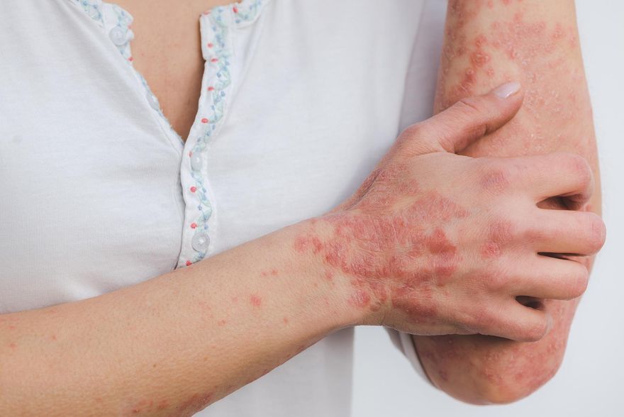 擺脫冬季癢！中醫教「內外雙修」保暖、補腎、保濕3管齊下！