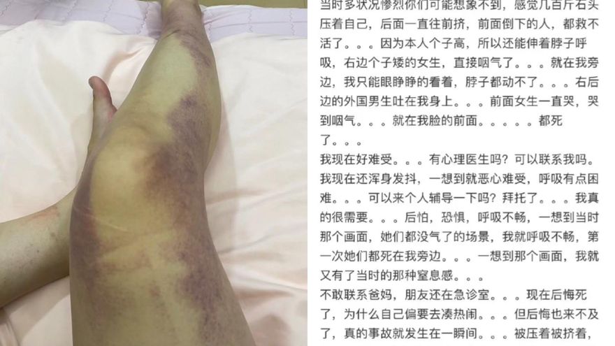 梨泰院10萬人踩踏/死裡逃生「全腿瘀青傷勢曝」　倖存女：眼睜睜看旁人嚥氣…