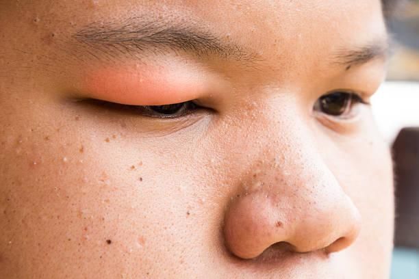小孩愛吃巧克力易長針眼！醫曝：嚴重得全身麻醉做手術