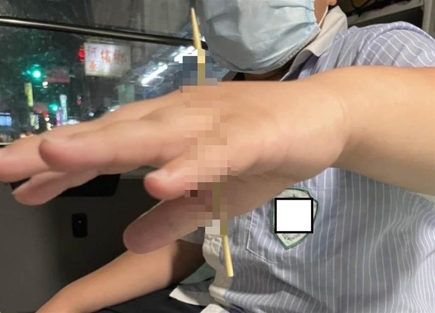 9歲男童拍破垃圾袋下秒慘了…手掌遭「10公分竹籤刺穿」嚇壞送醫