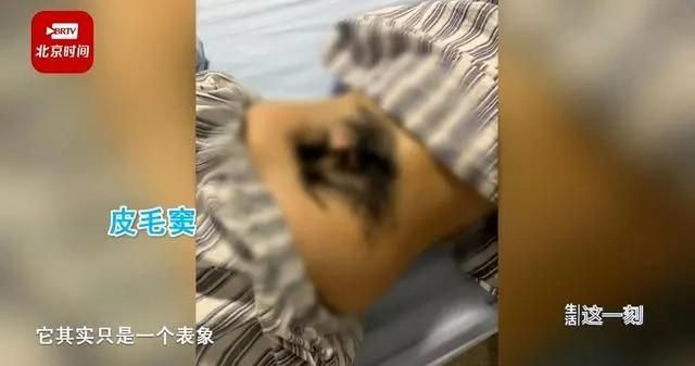 後腰長出「濃密黑森林」！17歲女孩染怪病醫曝是這原因…