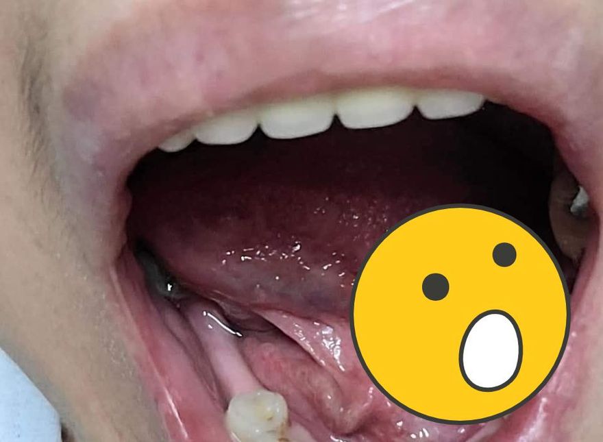 牙醫手滑鑽破口！病患傷口深到「棉花棒頭全插入」氣理論　他竟回：破皮而已