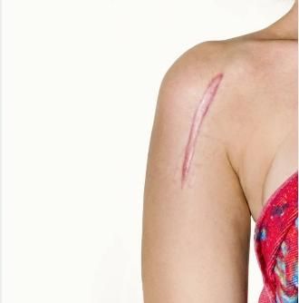 手術後不想留疤？整形醫師教「4件事」預防「蟹足腫」