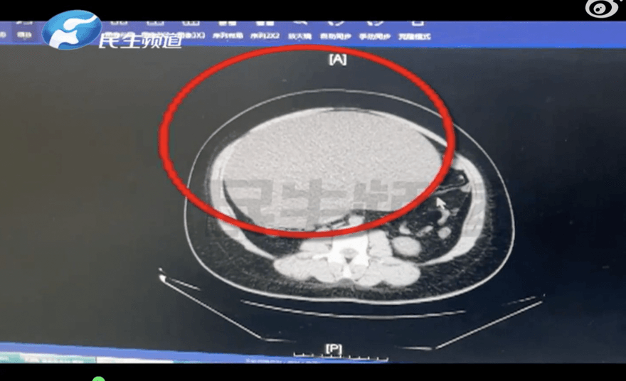 比足球還大！誤以為「發胖」狂減肥瘦不下來　竟是腹內長8公斤重卵巢囊腫
