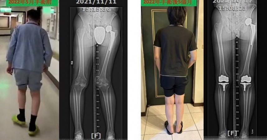 挑戰極限！重度血友病患者多關節一次換　 整合治療照護更全面