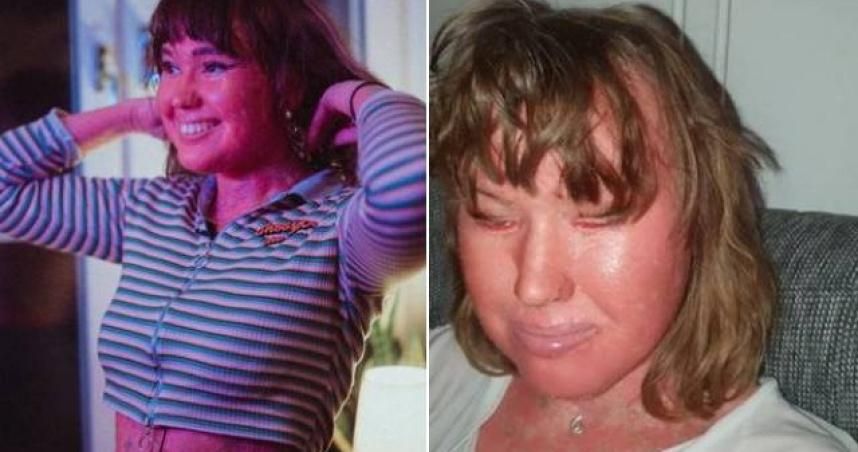嫩妹患罕病「皮膚像魚鱗」　飽受歧視遭譏「番茄」：妳不該活著！