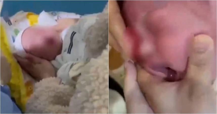 太誇張！天兵月嫂誤「拿酒精洗眼睛」　出生28天女嬰「眼角膜燒傷」哀號大哭