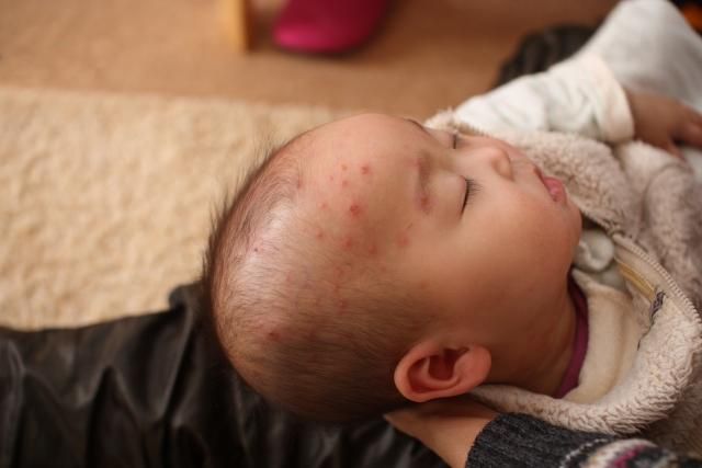 水痘拉警報！5招守護孩子健康：接種2劑疫苗保護力可達92%