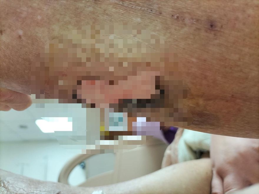 驚！老翁天冷用暖暖包竟「二度燒傷」　皮掀起留10公分疤！