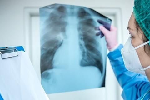 不吸菸卻罹患肺癌？ 小於一公分肺部結節「1檢查」就能偵測到