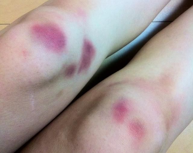 40歲女「全身瘀青」就醫傻眼竟是「肝癌」　醫揭「1狀況」要小心！