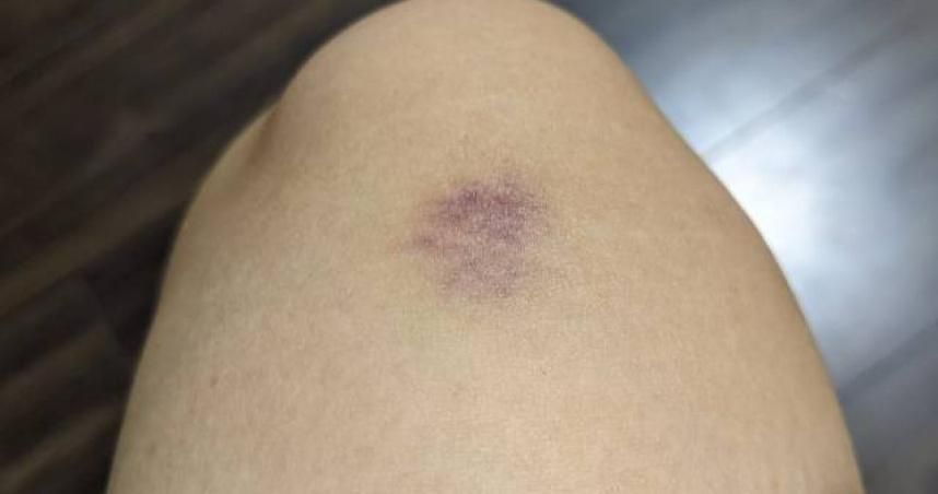 4歲童滿腿瘀青「疑遭暴力對待」　就醫檢查才知罹患嚴重疾病　肝腎恐出問題
