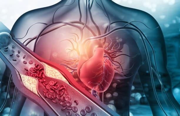 左腳時常比右腳腫脹？小心「髂靜脈壓迫」易併發急性靜脈栓塞