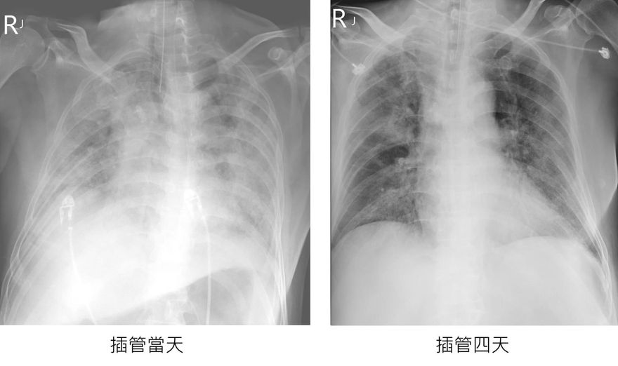 快訊/大白肺台商病情持續好轉! 肺浸潤部份減少一半！定序結果出爐 感染OmicronBA.5