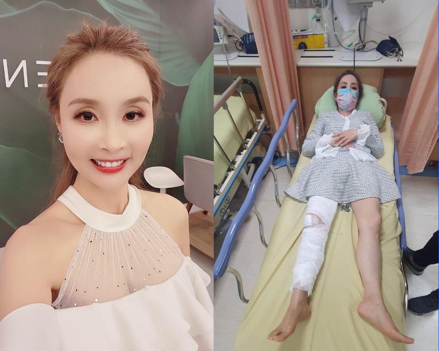 許聖梅拿大包小包慘摔「緊急送醫」！無奈揭「軟骨碎兩半」　躺床苦嘆：朋友全跑光